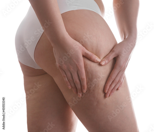 Woman with cellulite on white background, closeup photo