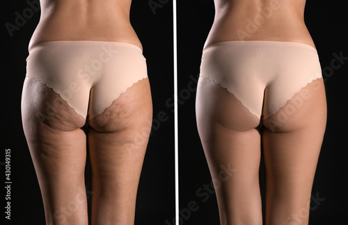 Collage with photos of woman before and after anti cellulite treatment on black background, photo