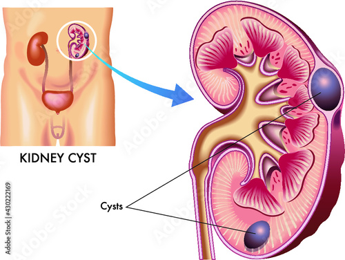 Medical illustration of a kidney with some cysts.