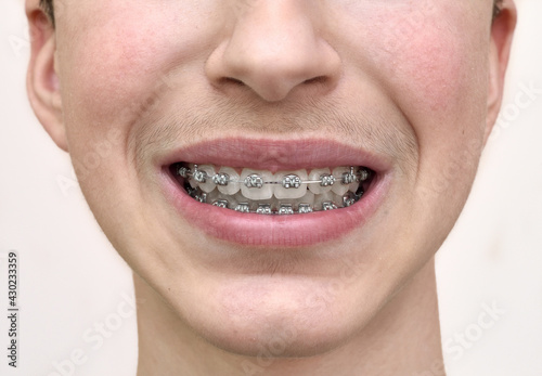 Teenage boy with braces on his teeth. Close-up.