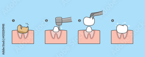 Step of real root tooth is restored by the crown tooth. illustration vector design on blue background. Dental care concept.