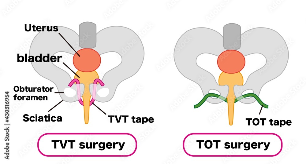 Urine leakage Medical illustration material for TVT surgery and TOT