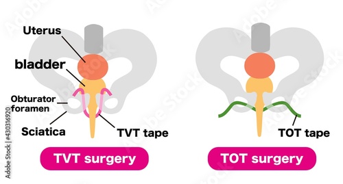 Urine leakage Medical illustration material for TVT surgery and TOT surgery