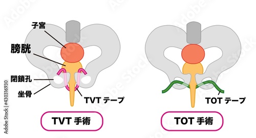 尿漏れ　TVT手術とTOT手術のメディカルイラスト素材