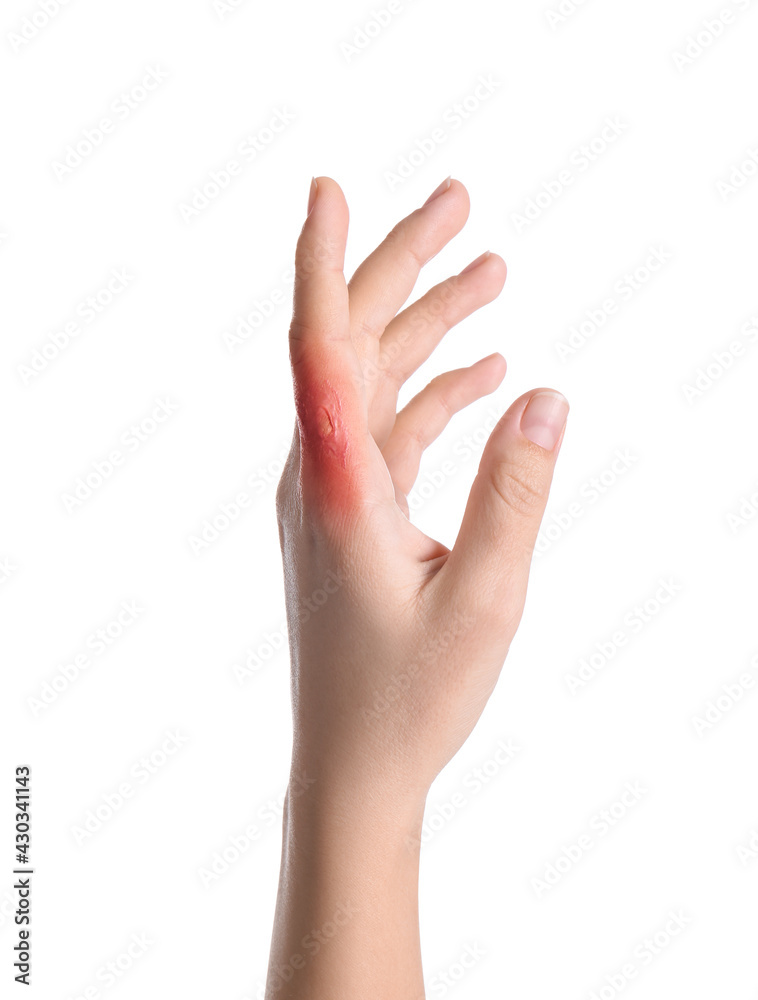 Fototapeta premium Woman with burn of her hand on white background, closeup