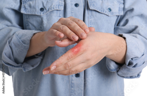 Woman with burn of her hand on white background, closeup