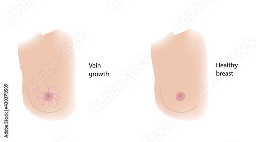 Woman healthy breast and Vein growth. Comparison. Medical vector illustration.