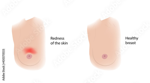 Woman healthy breast and Redness of the skin. Comparison. Medical vector illustration.