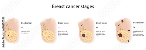 Woman breast cancer stages. T1, T2, T3, T4, metastasis, axillary lymph nodes. Medical vector illustration.