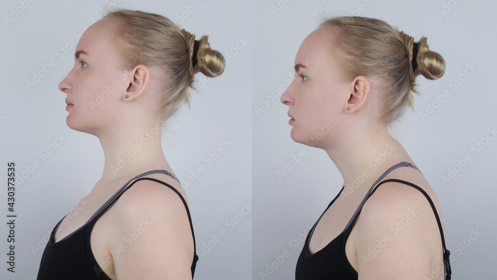 Before and after kyphosis. The woman suffers from a curvature of the
