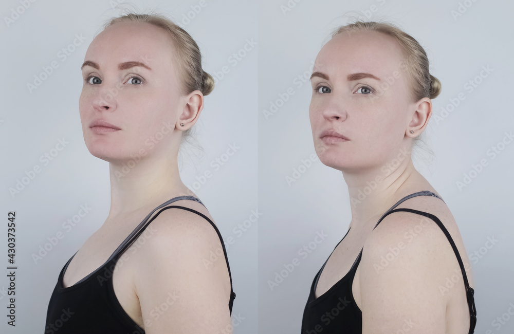 Before and after kyphosis. The woman suffers from a curvature of the