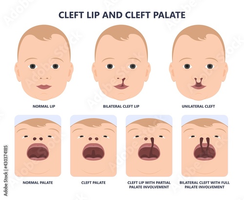 Cleft lip birth defect baby face nose Born gene drink bifid uvula roof Oral photo