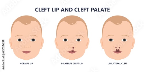 Cleft lip birth defect baby face nose Born gene drink bifid uvula roof Oral