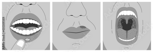 Canker sore, cold sore and sore throat. Black and white vector illustration of aphthous ulcer, chronic and bacterial tonsillitis.