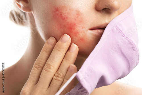 Obraz na plátně Maskne - acne breakouts from wearing a face mask