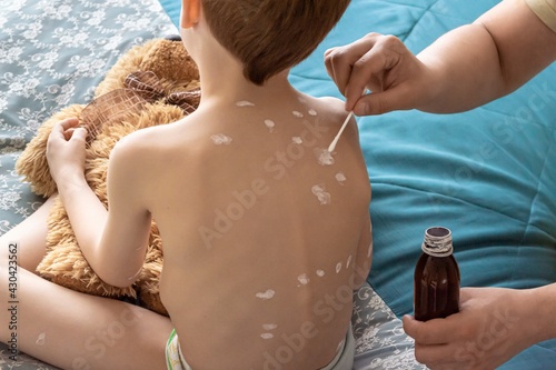 Childhood diseases chickenpox. Father taking care of the child, the process of applying anti-itch lotion on his son's back