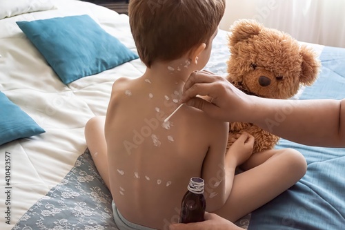 Treatment of chickenpox in a child, applying anti-itch lotion to the symptoms of the virus