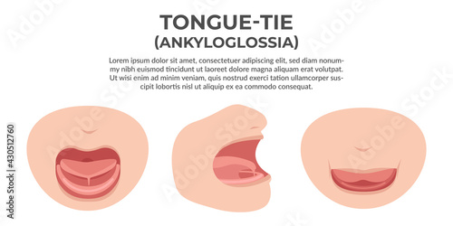 Tongue tie illustration, a health problem find common on new born baby