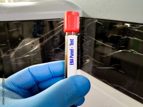 Biochemist holds Blood samples for Extractable nuclear antigen (ENA) test, diagnosis and distinguish between autoimmune disorders as well as to monitor autoimmune disease progression. photo