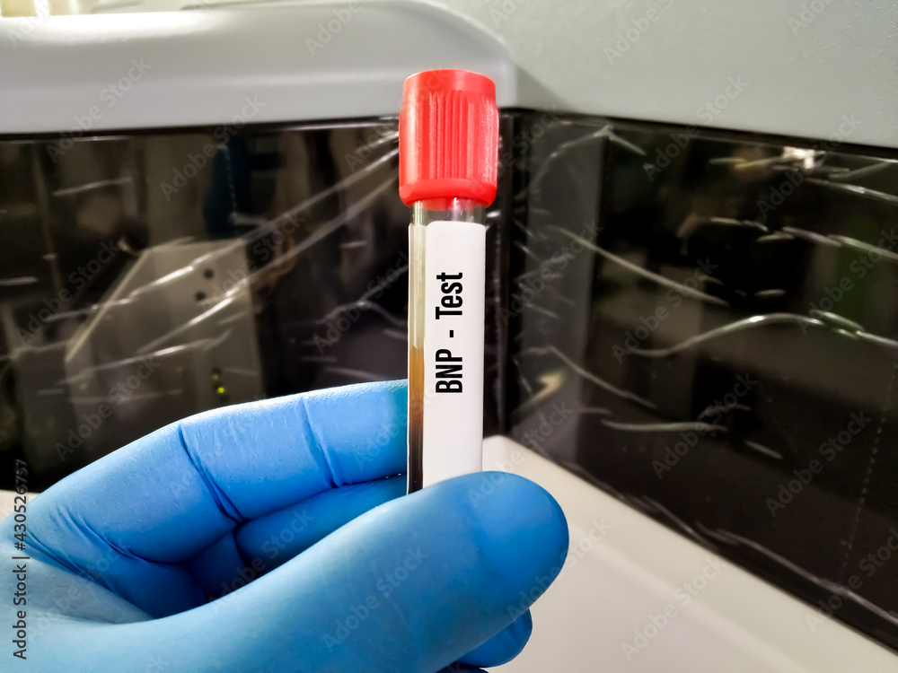 Blood sample for Nterminal pro Btype natriuretic peptide or NTproBNP