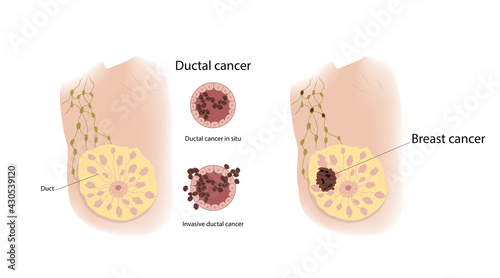 Woman breast and ductal cancer. Comparison. Medical vector illustration.