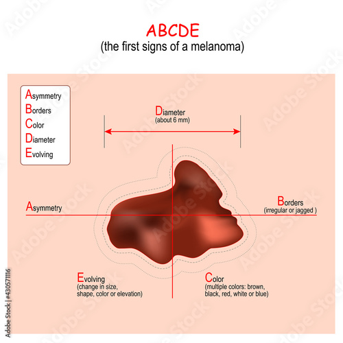 ABCDE. Melanoma. signs and Symptoms of Skin Cancer