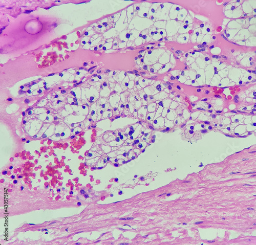 Photo of clear cell renal cell carcinoma with vascular invasion, magnification 400x, photo under microscope