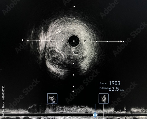 Intravascular ultrasound imaging (IVUS) shown guide wire in a false lumen during percutaneous coronary intervention (PCI) of chronic total occlusion (CTO) coronary artery. photo