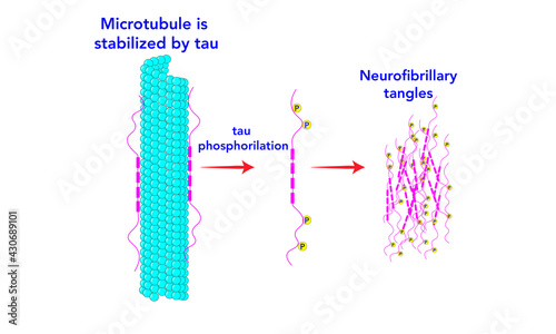 Neurofibrillary tangles [Tau proteins] microtubule photo