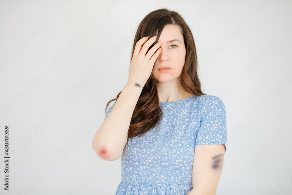 Woman with bruises and bruises covering one eye with her hair. Victim of violence. Violence in the family. Woman would be beaten Woman with bruises and bruises covering one eye with her hair. Victim of violence. Violence in the family. Woman would be beaten