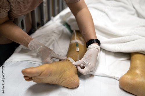 Hands of nurse is assisting a patient lying on a hospital bed by giving saline solution to the leg or a needle to puncture into ankle to deliver platelets due to swelling the patient's hand or wrist