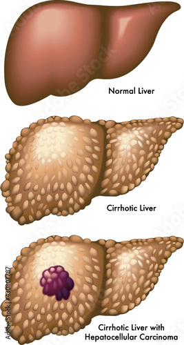 Medical illustration shows the difference between a normal liver, one with cirrhosis and one with cirrhosis and hepatocellular carcinoma, with annotations.