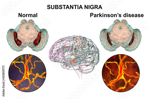 Substantia nigra of the midbrain and its dopaminergic neurons in normal state and in Parkinson's disease, 3D illustration. photo