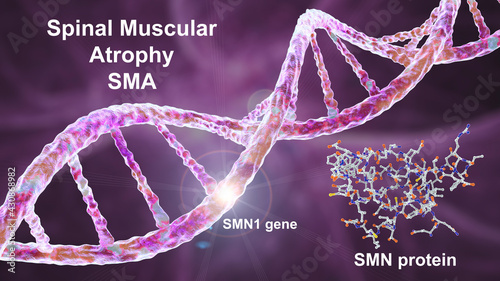 Spinal muscular atrophy, SMA, a genetic neuromuscular disorder with progressive muscle wasting photo