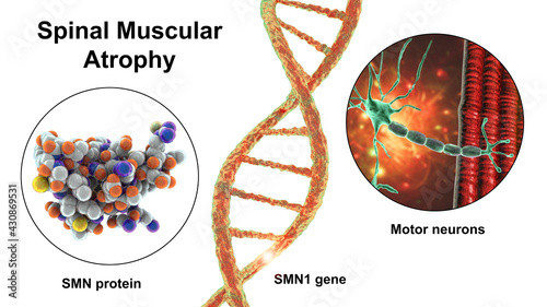 Spinal muscular atrophy, SMA, a genetic neuromuscular disorder with progressive muscle wasting