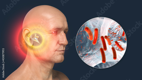 Otitis media, inflammatory disease of the middle ear, 3D illustration photo