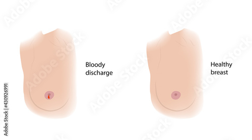Woman healthy breast and Bloody discharge. Comparison. Medical vector illustration.