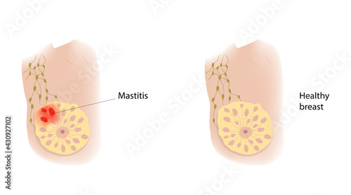 Woman healthy breast and mastitis. Comparison. Medical vector illustration.