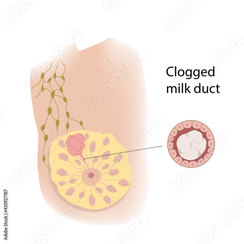 Woman breast. Clogged milk duct view with description. Medical vector illustration.