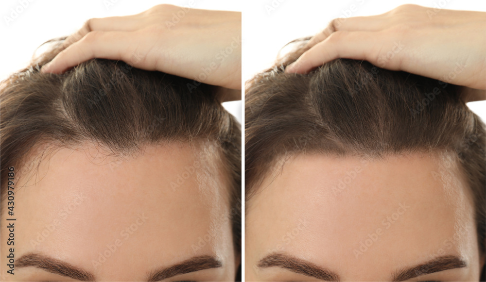 Fototapeta premium Woman suffering from baldness on white background, closeup. Collage with photos before and after treatment