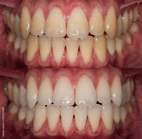Before and after teeth bleaching