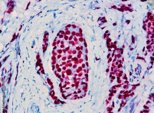 Foto Lobular carcinoma of the breast with strong red nuclear expression of the tumor marker called estrogen receptor or ER