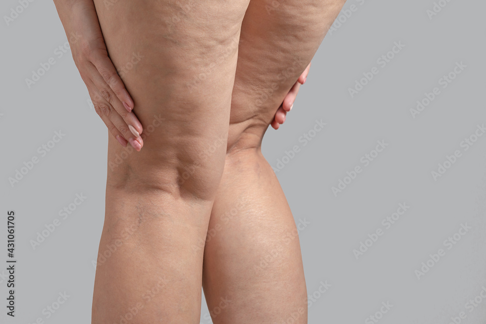 Stretch marks, cellulite and varicose veins on female legs. Copyspace - obrazy, fototapety, plakaty 
