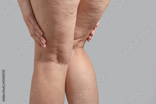 Stretch marks, cellulite and varicose veins on female legs. Copyspace