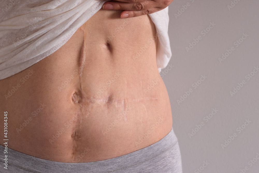 Multiple scars on woman's abdomen from surgery Stock Photo | Adobe Stock
