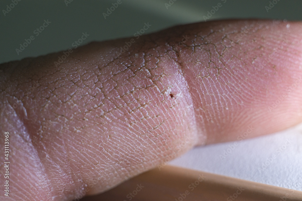 a splinter in a person's finger a splinter in a person's finger