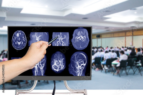 Принти на полотні MRA brain or Magnetic resonance angiography of a cerebral artery in the brain with hand doctor pointed out that abnormal blood vessels in the brain