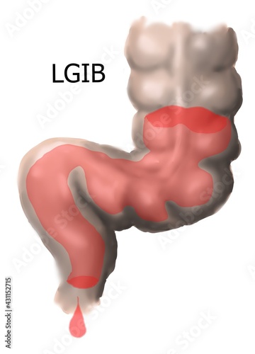The bleeding in lower gastrointestinal tract.