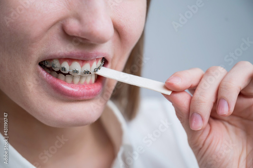 Young woman with metal braces on her teeth is chewing gum. The girl is eating gummy candy