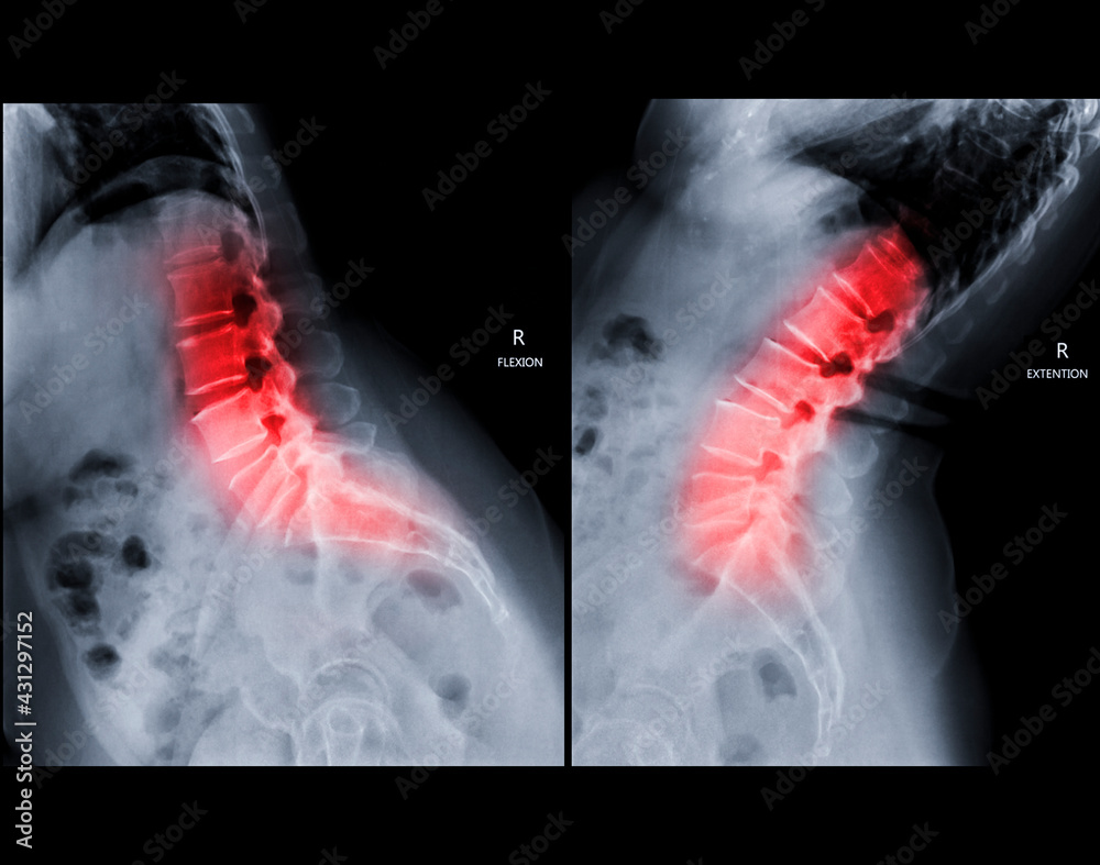 Xray image of lumbar Spine lateral Flexion and Extension view showing